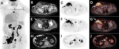 Case report: Low-grade myofibroblastic sarcoma resembling lymphoma on 18F-FDG PET/CT